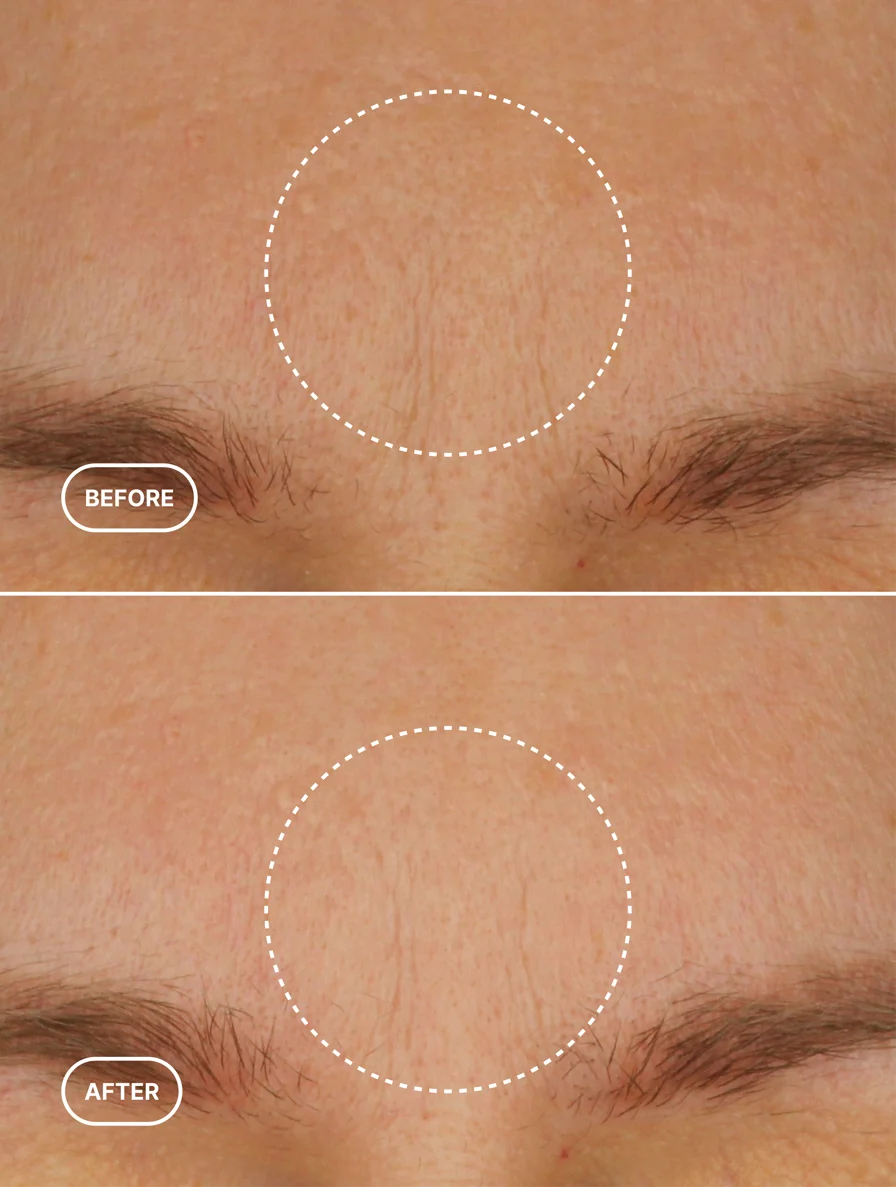 Before and after results showing reduced appearance of fine lines on forehead using Lueur Beaute Retinol Alternative Moisturiser
